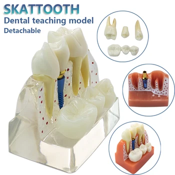 Zobu Implantācija Modelis Vainagu Tilta Modeli, Izņemamo Zobu Modeli Zobu Mācību Zobārstu Apmācību Zobu Demonstrēšanas Modelis